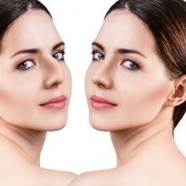 Rhinoplastie : les complications postopératoires