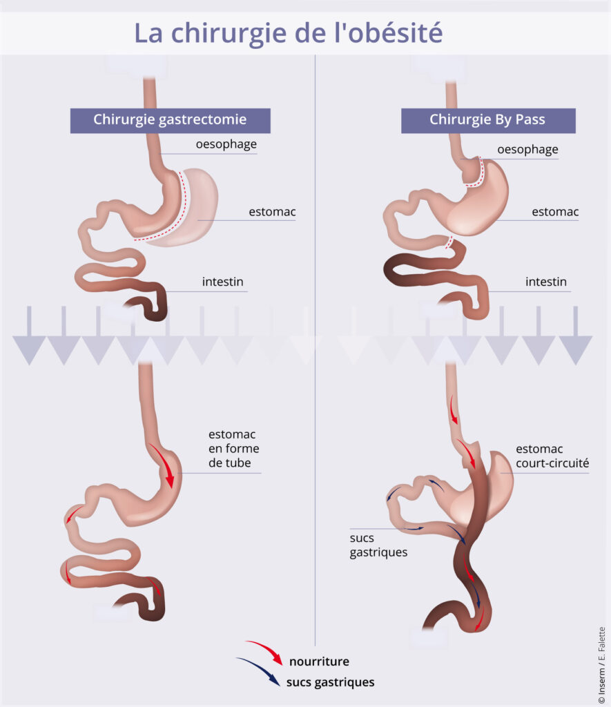 difference bypass et sleeve